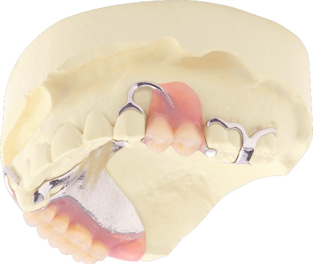部分床義歯（部分入れ歯）
